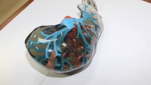 Dokuz Eylül Üniversitesi’nden  karaciğer naklinde   devrim