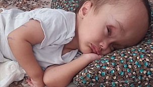 Doğuştan hidrosefali hastası bebek ameliyat edildi