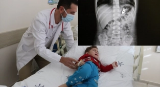 Murat'ın midesinden 17 boncuk mıknatıs çıkarıldı