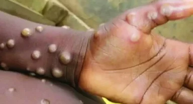 Maymun çiçeği virüsü nedir ve nasıl bulaşır?