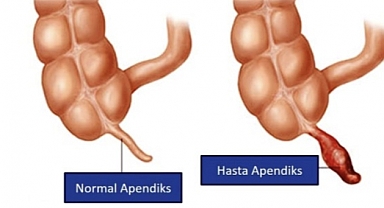 Çocuklarda Apandisitin Tanı Ve Tedavisi
