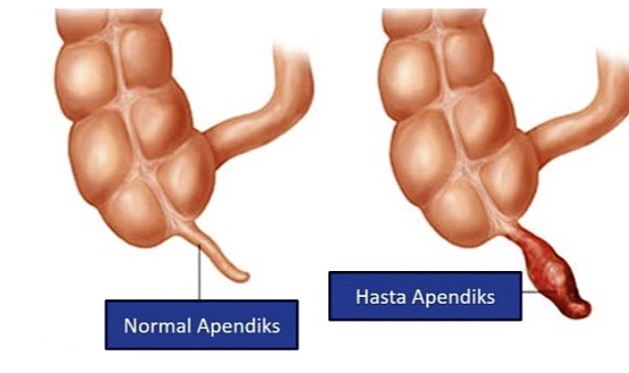 Çocuklarda Apandisitin Tanı Ve Tedavisi